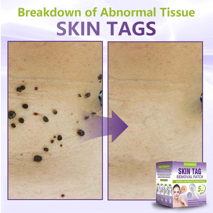 Oliokindred® Soluble Microneedle Botanical Skin Tag Removal Patch