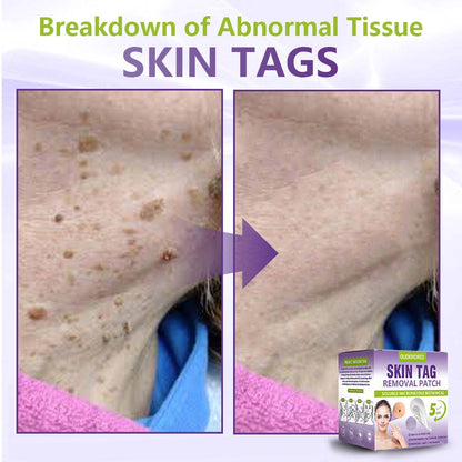 Oliokindred® Soluble Microneedle Botanical Skin Tag Removal Patch
