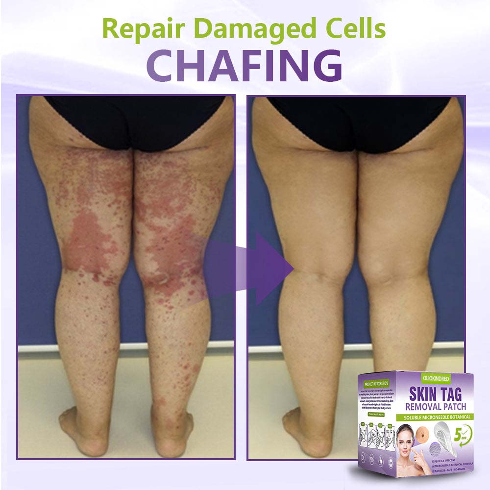 Oliokindred® Soluble Microneedle Botanical Skin Tag Removal Patch