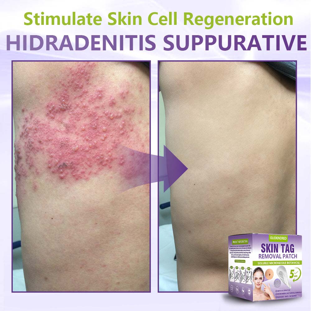 Oliokindred® Soluble Microneedle Botanical Skin Tag Removal Patch