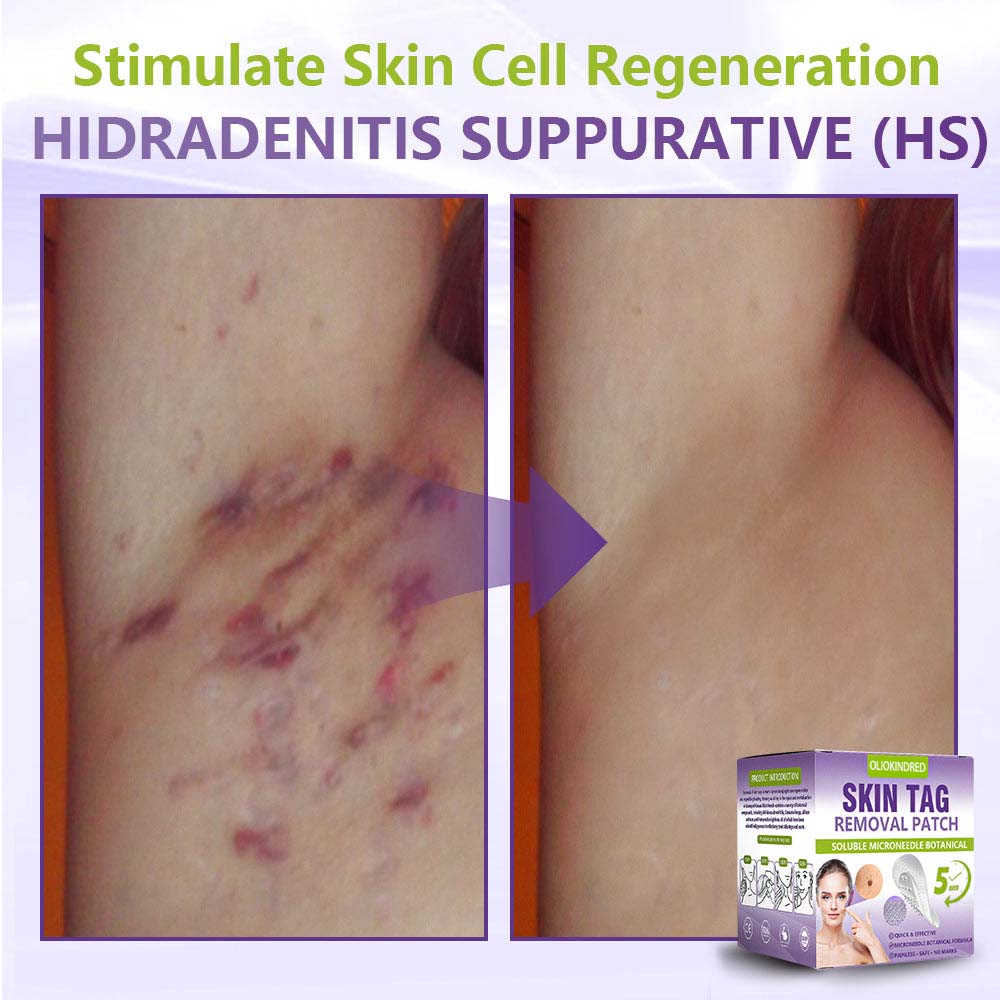 Oliokindred® Soluble Microneedle Botanical Skin Tag Removal Patch