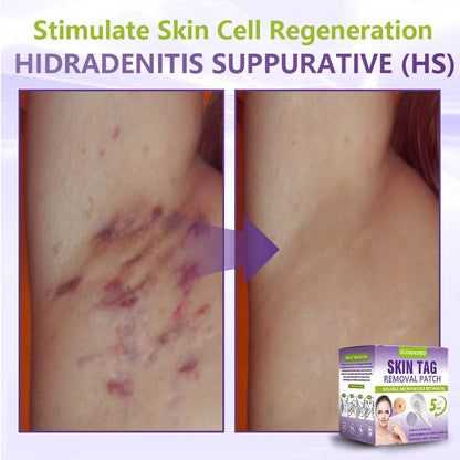 Oliokindred® Soluble Microneedle Botanical Skin Tag Removal Patch
