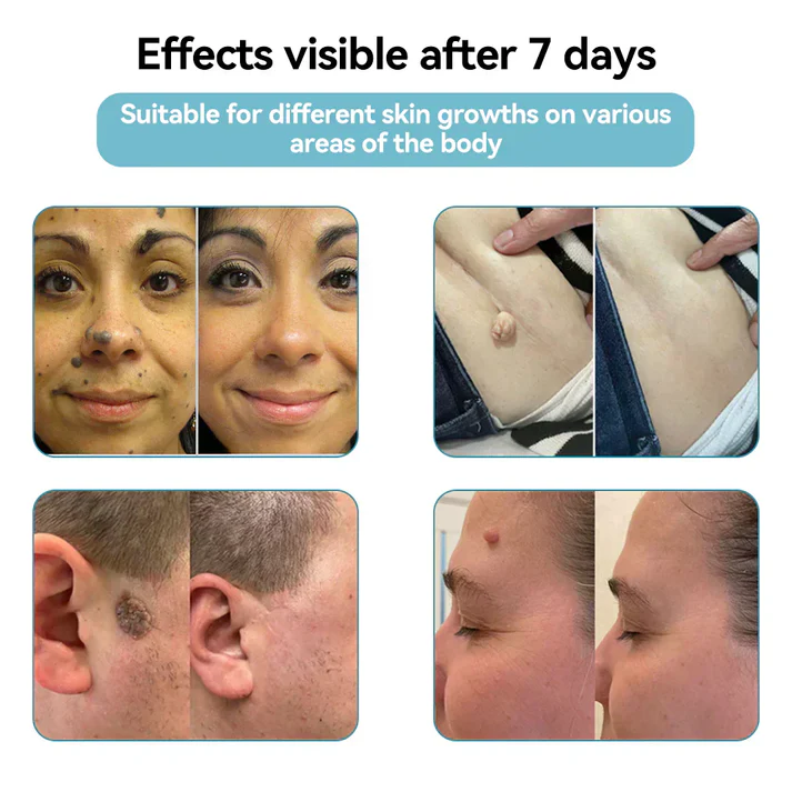 Hopearve™ All-in-One CO₂ Laser Eraser Pen | Removes Moles, Warts, Skin Flaws & Pigmentation