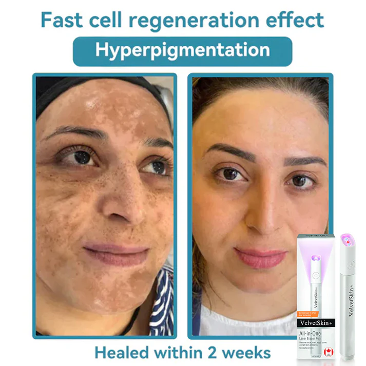 Hopearve™ All-in-One CO₂ Laser Eraser Pen | Removes Moles, Warts, Skin Flaws & Pigmentation