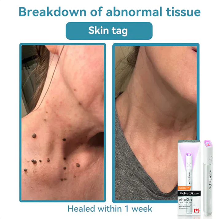Hopearve™ All-in-One CO₂ Laser Eraser Pen | Removes Moles, Warts, Skin Flaws & Pigmentation
