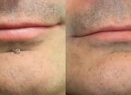 ✨OLIOKINDRED®2-in-1 Microneedle & Hydrocolloid Patch🍀| Removes Raised Moles, Acne, Flat Warts & Skin Tags | Helps Improve Wrinkles, Scars & Blemishes | Invisible Patches for Face & Body