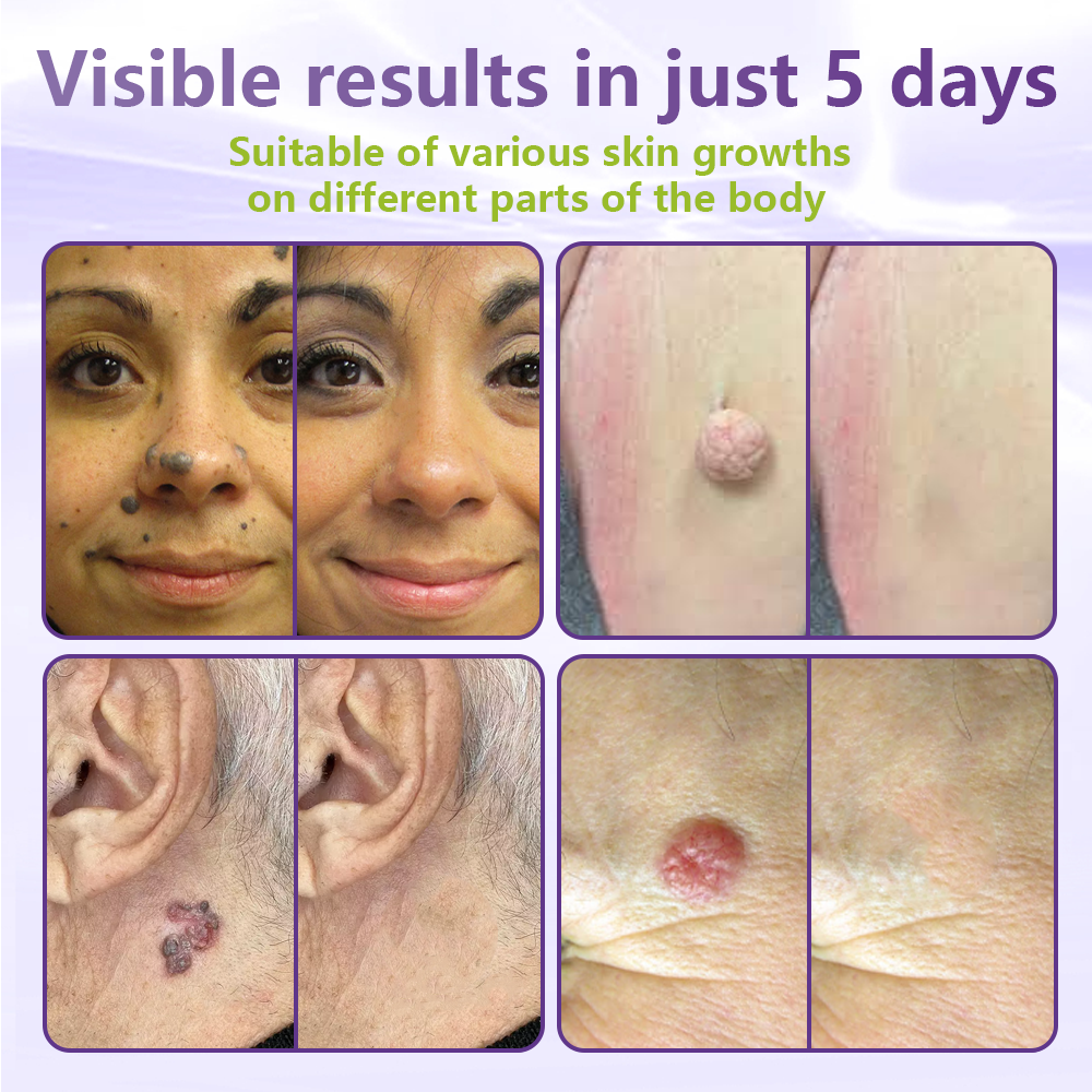 Oliokindred® Soluble Microneedle Botanical Skin Tag Removal Patch