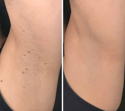 ✨OLIOKINDRED®2-in-1 Microneedle & Hydrocolloid Patch🍀| Removes Raised Moles, Acne, Flat Warts & Skin Tags | Helps Improve Wrinkles, Scars & Blemishes | Invisible Patches for Face & Body