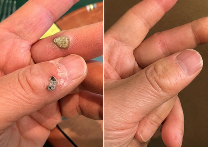 ✨OLIOKINDRED®2-in-1 Microneedle & Hydrocolloid Patch🍀| Removes Raised Moles, Acne, Flat Warts & Skin Tags | Helps Improve Wrinkles, Scars & Blemishes | Invisible Patches for Face & Body